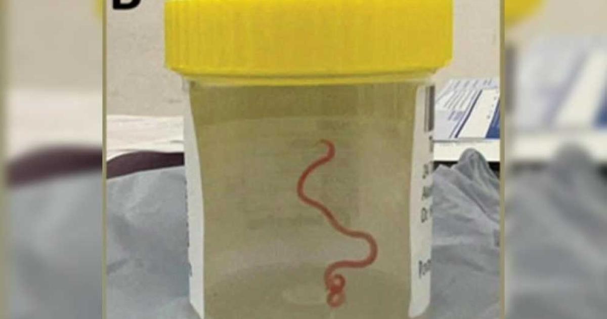 Australia: Eight cm long live worm found in woman’s brain