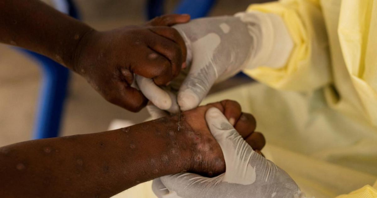 Monkeypox outbreak: UNICEF launches emergency vaccine tender